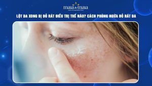 Lột da xong bị đỏ rát