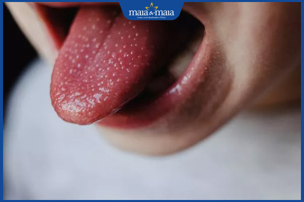 lưỡi nổi sẩn do sốt
