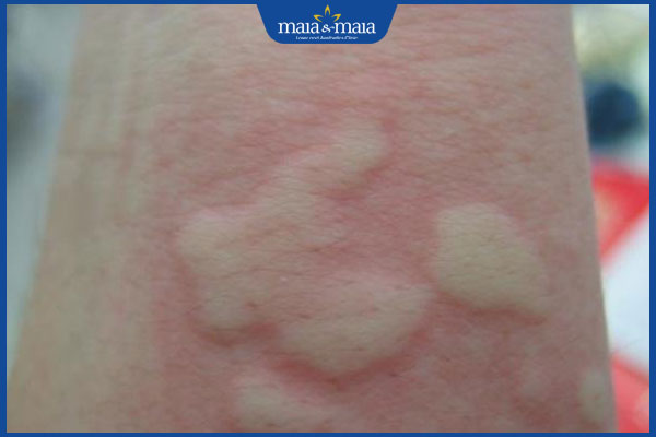 mề đay do dị ứng