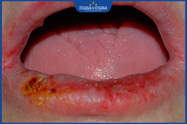 Nhận biết các dạng viêm môi thường gặp và hướng điều trị 3 môi viêm nhiễm trùng