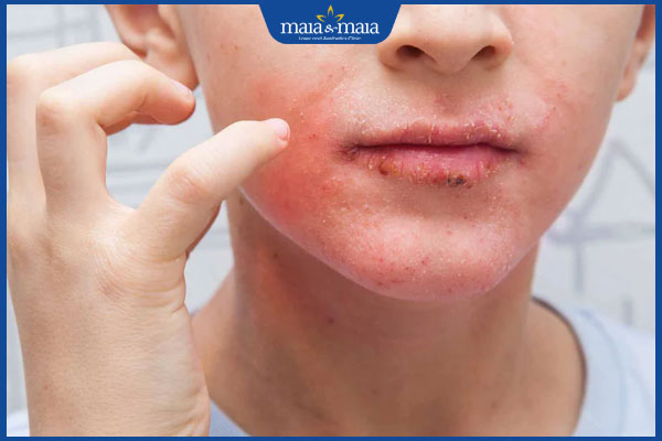 ngứa mặt dữ dội