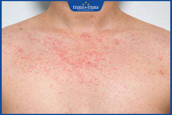 người lớn bị phát ban