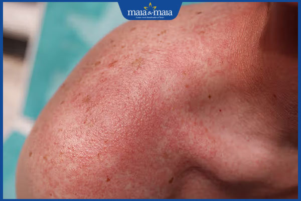 người lớn phát ban toàn thân