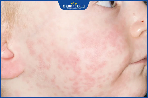 nhận biết ban đào ở trẻ em