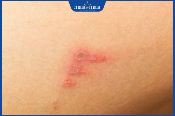 nhận biết chốc lở ở mông