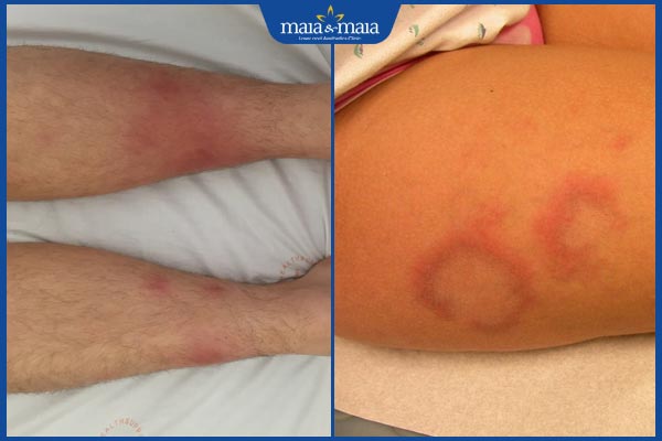 nhận biết hồng ban nút và lupus ban đỏ