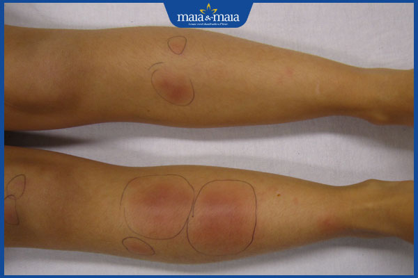 nhận biết hồng ban rắn bazin