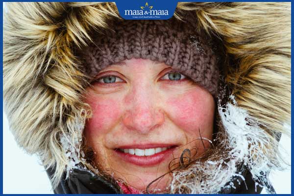 nhận biết phát ban mùa đông