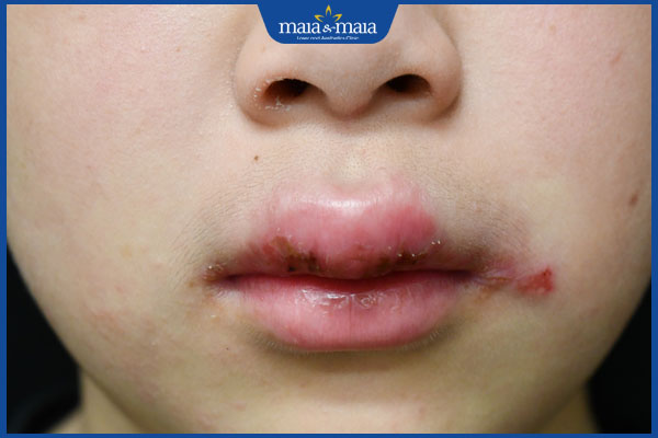 Viêm môi dạng u hạt có nguy hiểm không? Cách xử lý hiệu quả 3 nhận biết tình trạng viêm môi u hạt