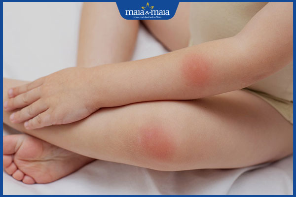 nhận biết viêm mô tế bào ở trẻ em