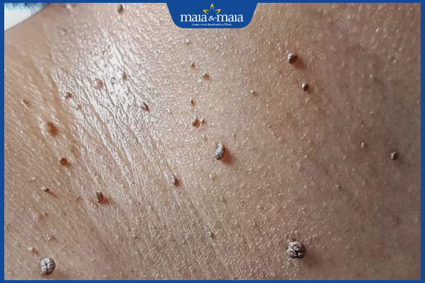 nhiều nốt u mềm treo