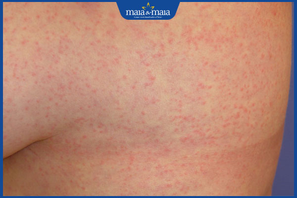 nổi ban sốt xuất huyết