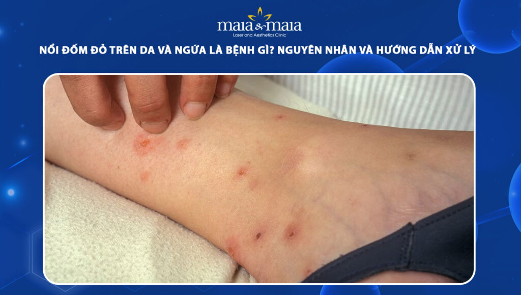 nổi đốm đỏ trên da và ngứa