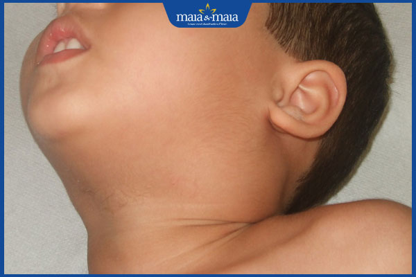 Sốt phát ban nổi hạch có dấu hiệu gì? Cách điều trị thế nào? 3 nổi hạch ở mang tai