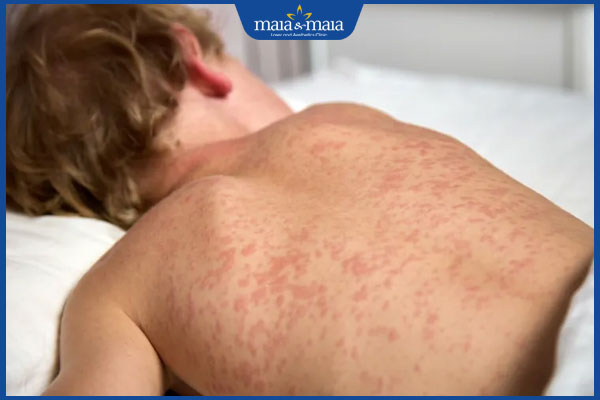 nổi phát ban sau tiêm vaccine