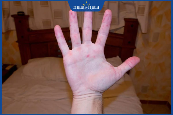 nốt ban mờ dần