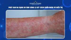 Phát ban đa dạng do ánh sáng