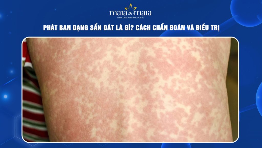 Phát ban dạng sẩn dát là gì? Cách chẩn đoán và điều trị 1 Phát ban dạng sẩn dát