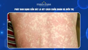 Phát ban dạng sẩn dát