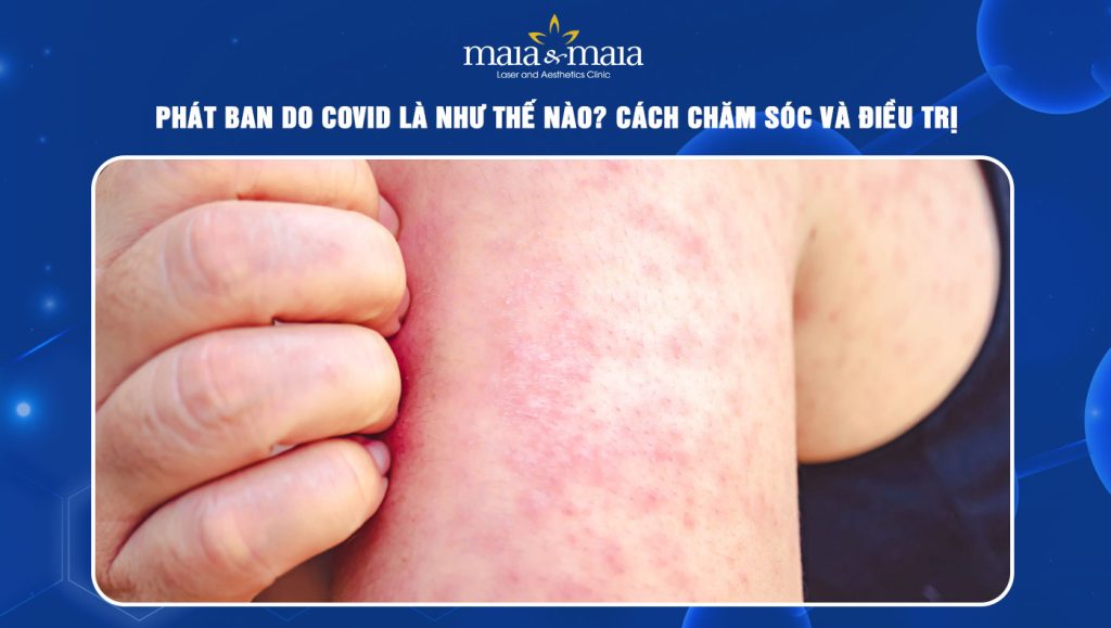 phát ban do Covid