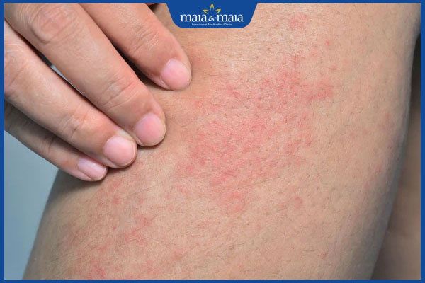 phát ban gây ngứa