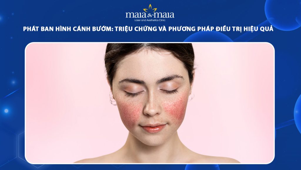 phát ban hình cánh bướm