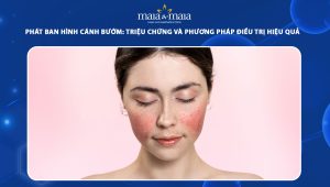 phát ban hình cánh bướm