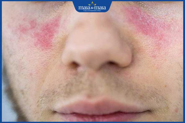 phát ban hình cánh bướm ở mặt