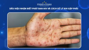 phát ban hiv