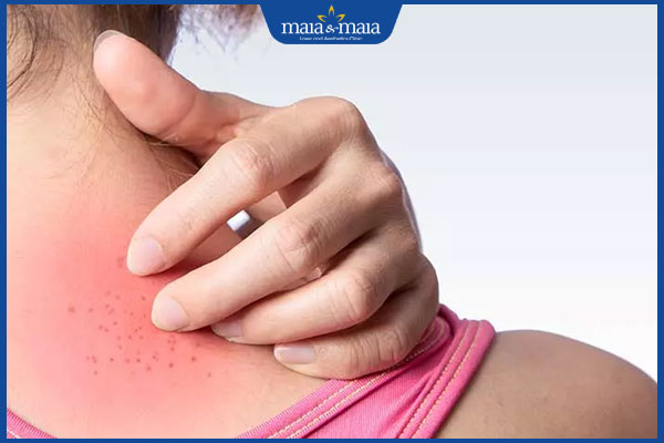 Dấu hiệu nhận biết phát ban HIV và cách xử lý khi gặp phải 6 phát ban hiv gây ngứa