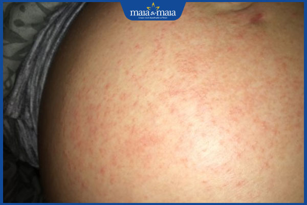 Sốt phát ban khi mang thai: Nguyên nhân và cách chăm sóc 2 phát ban khi mang thai