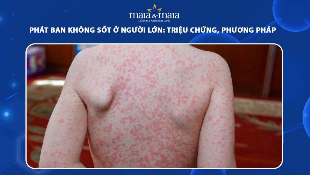 phát ban không sốt ở người lớn