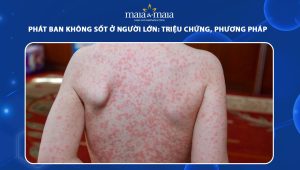 phát ban không sốt ở người lớn