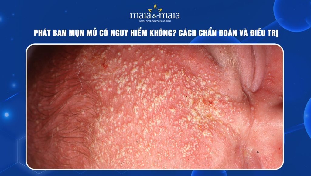 Phát ban mụn mủ