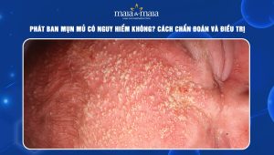 Phát ban mụn mủ