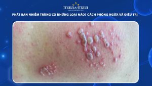 phát ban nhiễm trùng