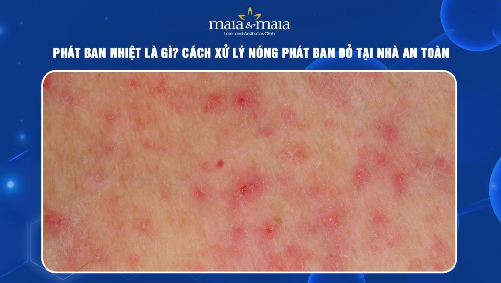 Phát ban nhiệt