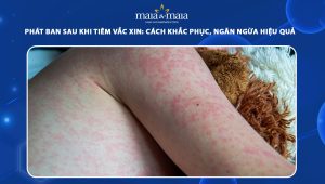 phát ban sau khi tiêm vắc xin