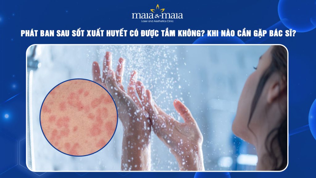 phát ban sau sốt xuất huyết có được tắm không