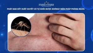 phát ban sốt xuất huyết