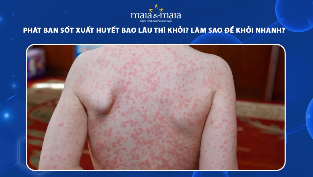 phát ban sốt xuất huyết bao lâu thì khỏi