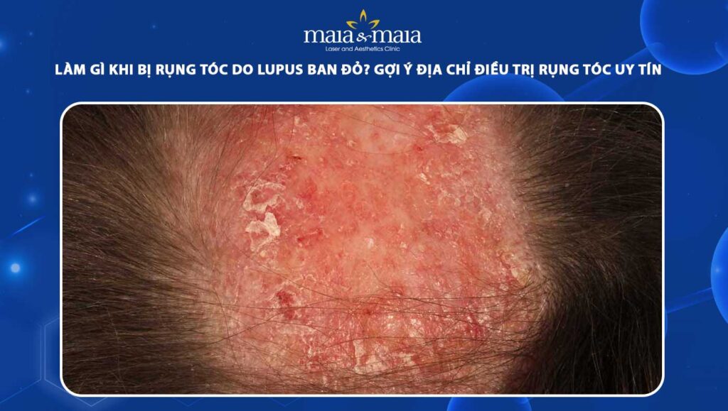 rụng tóc do lupus ban đỏ
