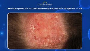 rụng tóc do lupus ban đỏ