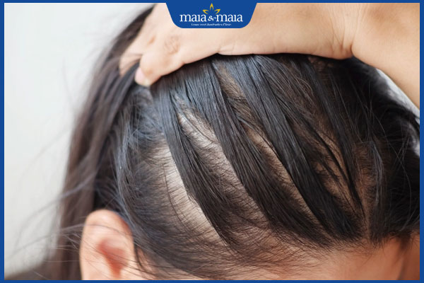 rụng tóc do nội tiết tố