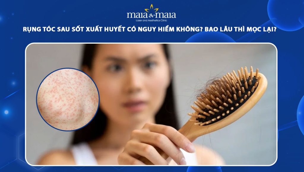 rụng tóc sau sốt xuất huyết