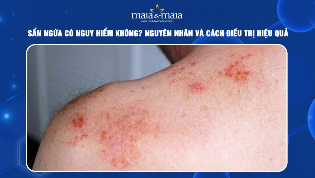sẩn ngứa