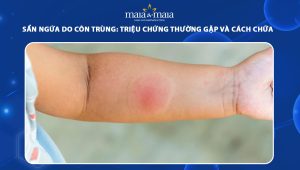 sẩn ngứa do côn trùng