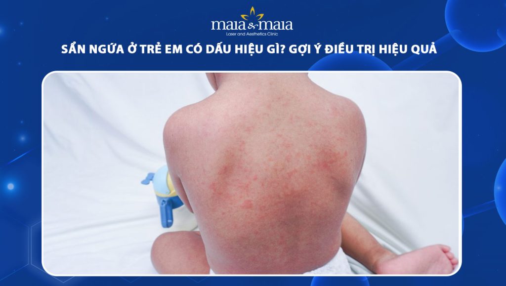sẩn ngứa ở trẻ em