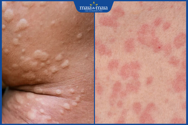 Phát ban dạng sẩn dát là gì? Cách chẩn đoán và điều trị 2 sẩn và dát