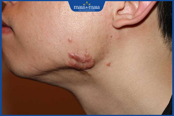 Sẹo viền hàm có những loại nào? Phương pháp xóa sẹo an toàn 2 sẹo lồi ở viền hàm